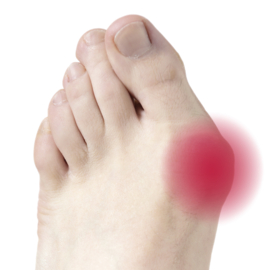 Fresco Deramed hallux valgus beschermer met zachte gelpad