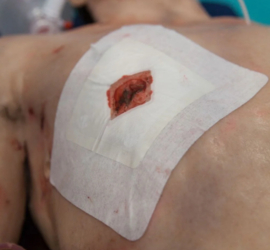 Russell Chest Seal
