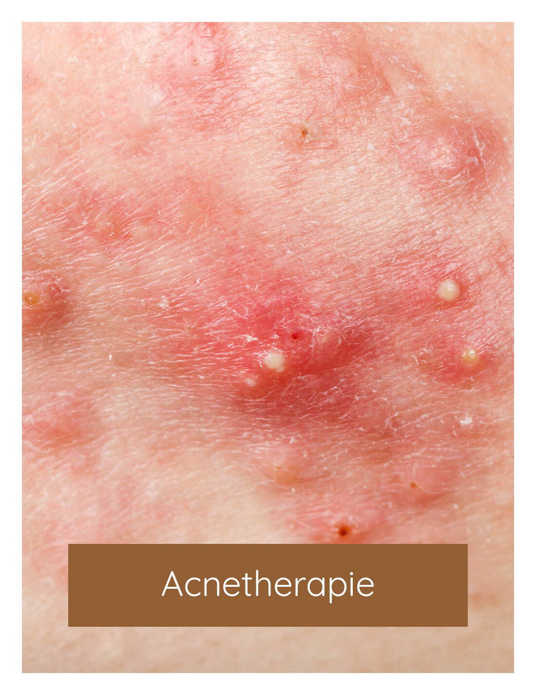 Acnetherapie, acne therapie, acne behandelen | Huidzaken