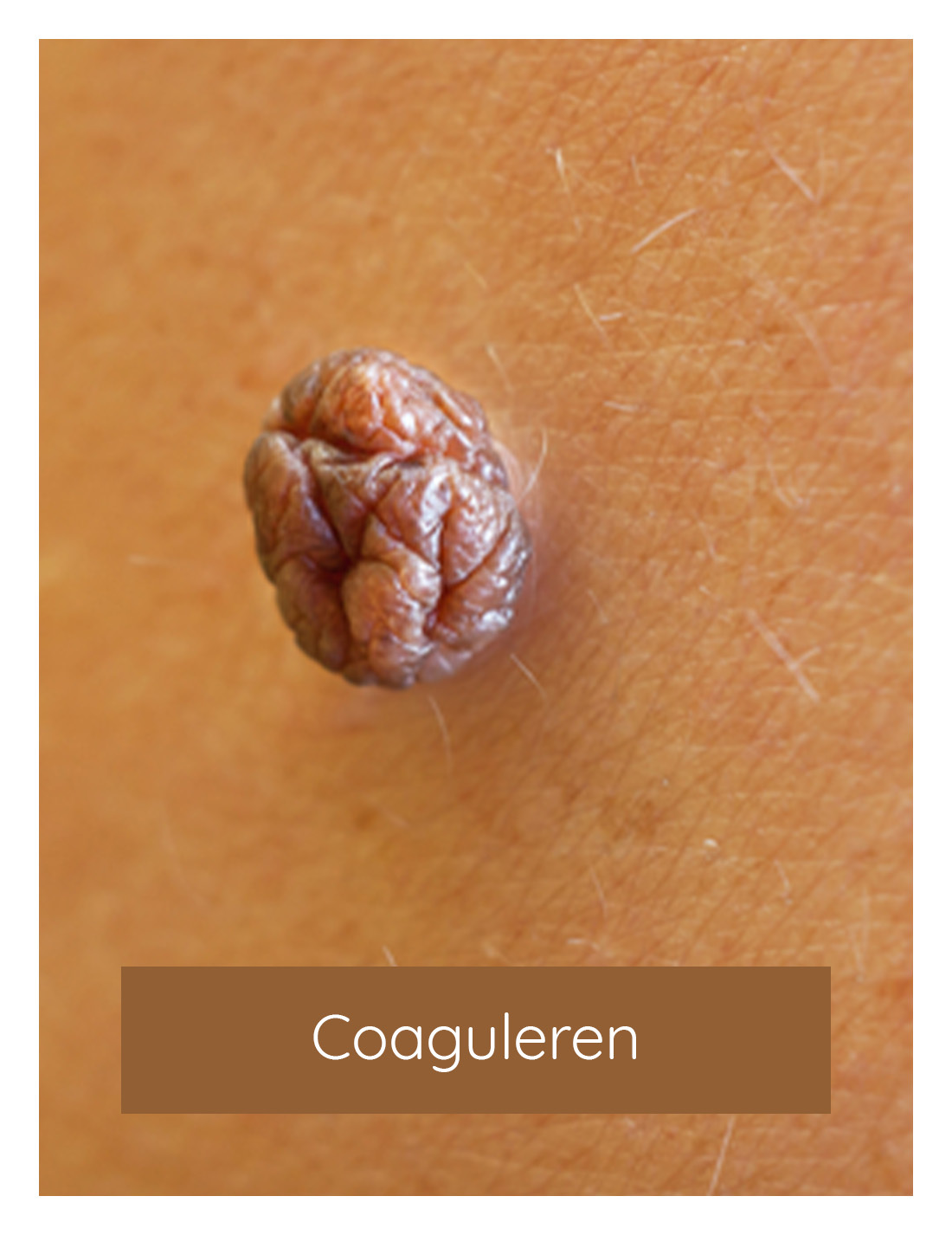 Coaguleren, fibromen, fibroom behandelen | Huidzaken