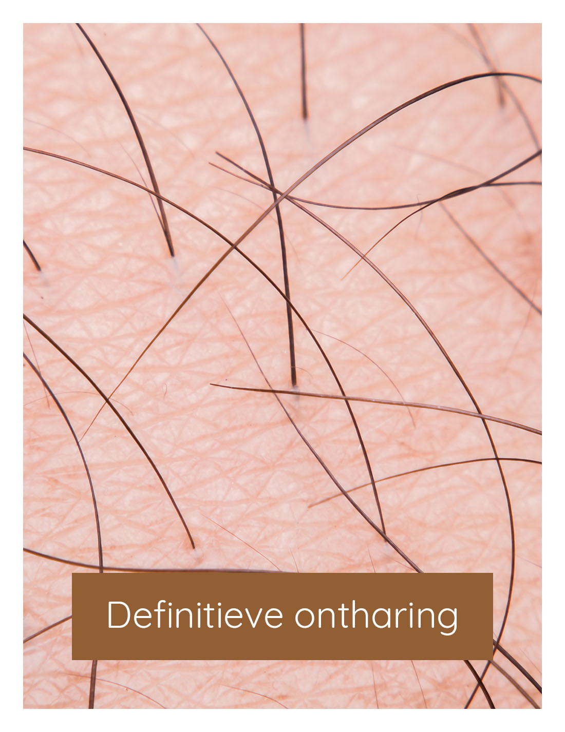 Definitieve ontharing, laser ontharing, ontharen laseren | Huidzaken