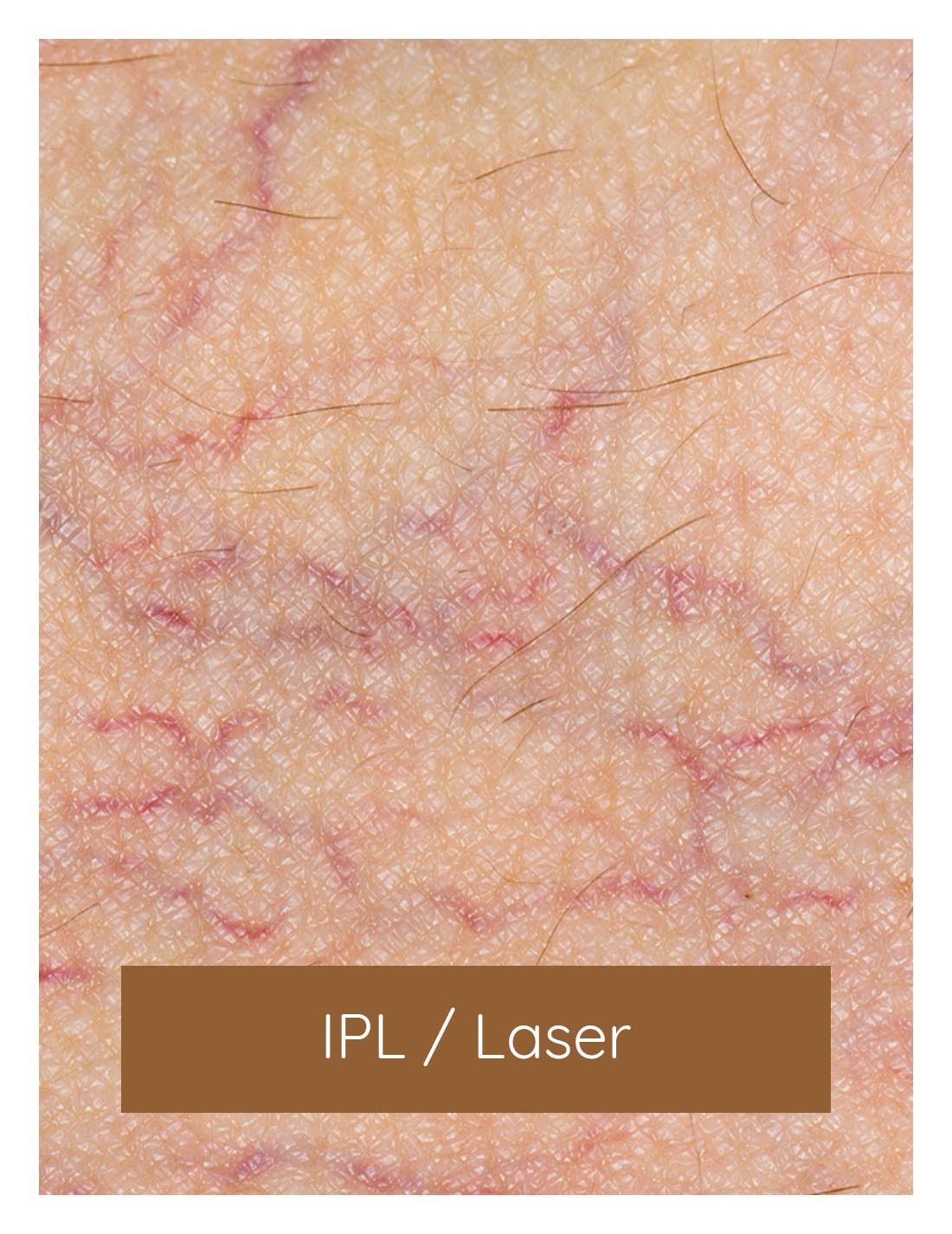 IPL behandeling, laserbehandelingen, verwijde vaatjes behandelen | Huidzaken