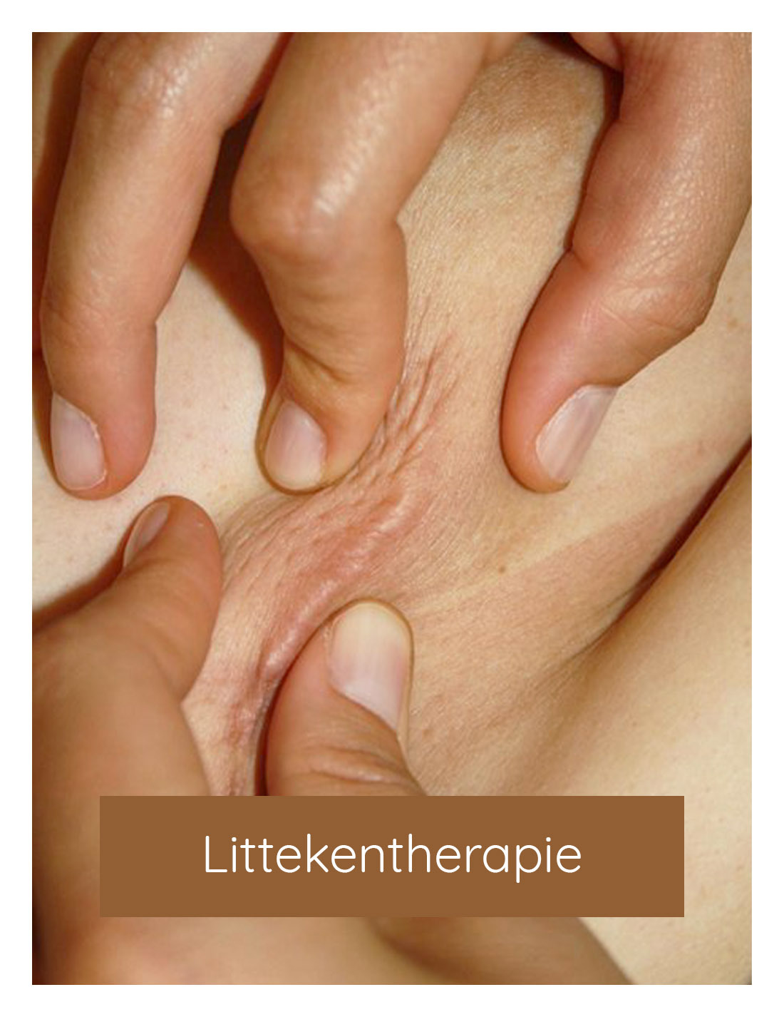 Littekentherapie, litteken behandelen, litteken massage | Huidzaken