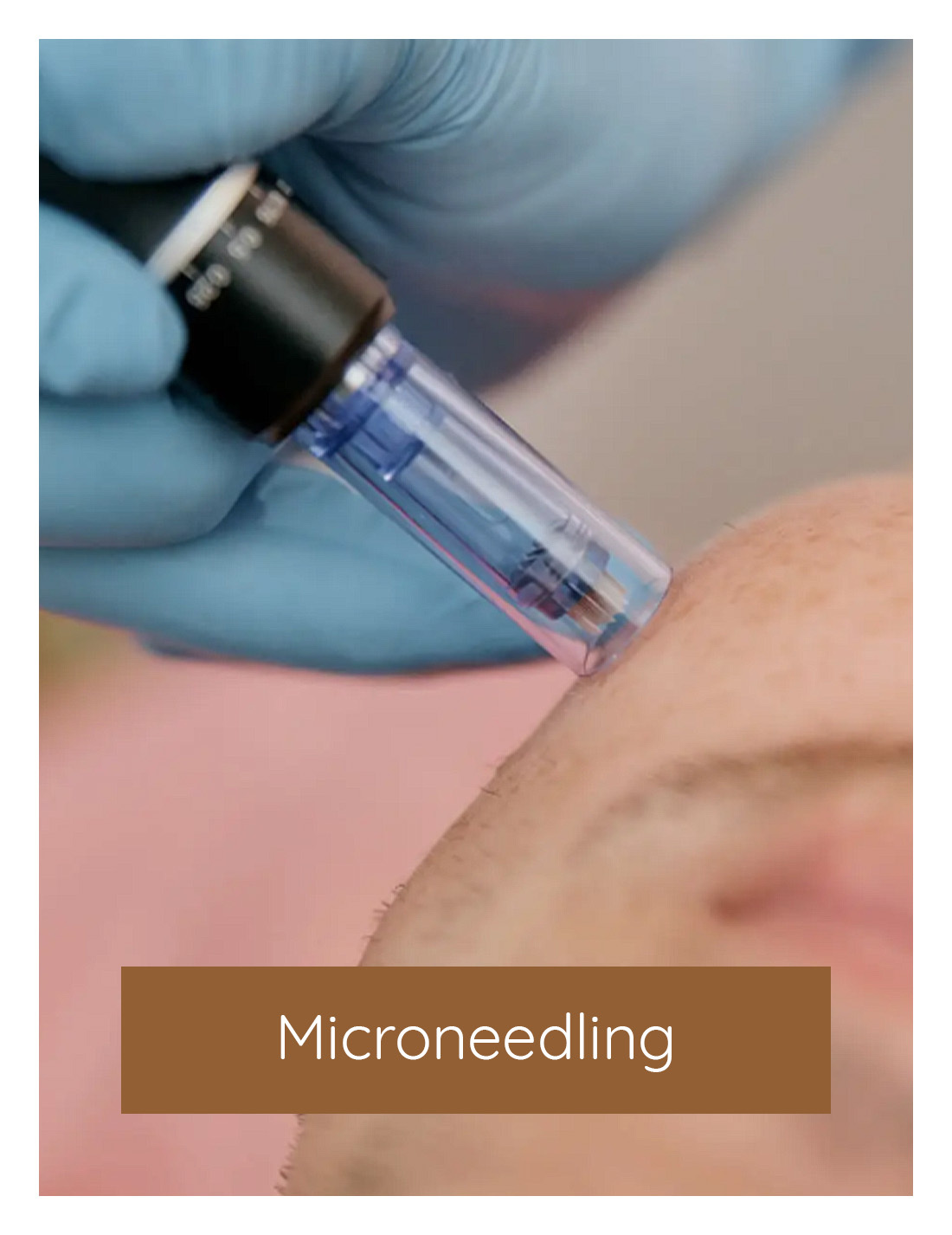 Microneedling, cosmetische behandeling | Huidzaken