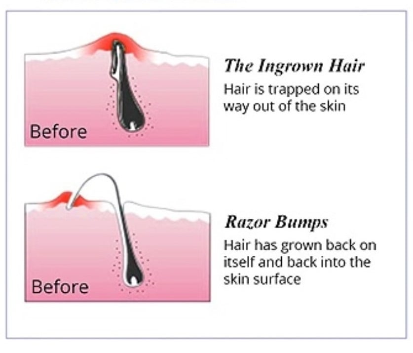 How to get rid of ingrown hairs safely in 3 effective steps  CNN  Underscored