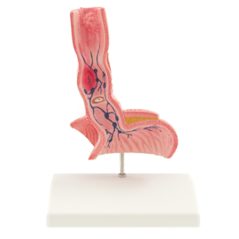 HEINE SCIENTIFIC Anatomisch model slokdarm met ziektebeelden