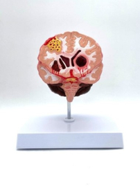 Anatomisch model van het brein met pathologieën