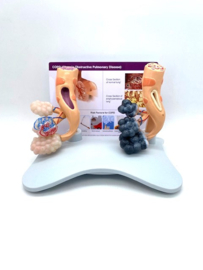 Anatomisch model Alveoli-bronchus roken