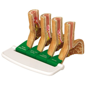 Anatomisch model Refluxziekte (GERD)