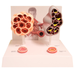 Anatomisch model Alveoli-bronchus COPD