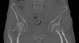 Erler Zimmer Bekken met femurhalsfractuur voor de training van CT, Röntgen- en radiotherapie