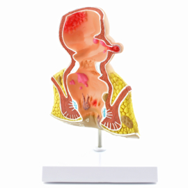 HEINE SCIENTIFIC Anatomisch model rectum met aambeien
