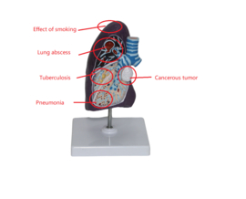 Anatomisch model van de rechter long met pathologieën