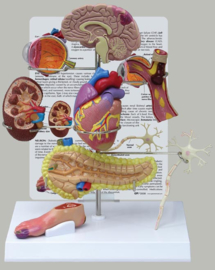 Anatomisch model Diabetes type 2