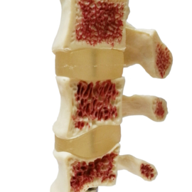 HEINE SCIENTIFIC Anatomisch model wervels met osteoporose