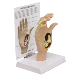 Anatomisch model Hand met artrose