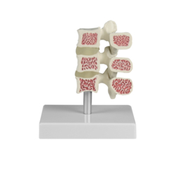 Anatomisch model Osteoporose wervel