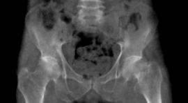 Erler Zimmer Bekken met femurhalsfractuur voor de training van CT, Röntgen- en radiotherapie