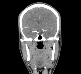 Erler Zimmer Hoofd-hals voor de training van CT, Röntgen- en radiotherapie