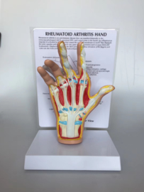 Anatomisch model Hand met reumatische artritis