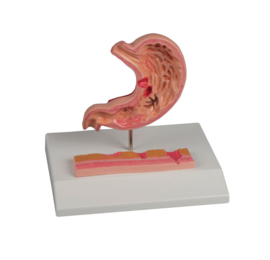 Anatomisch model Maag met 7 ziektebeelden