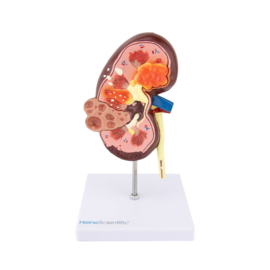 HEINE SCIENTIFIC Anatomisch model nier met ziektebeelden