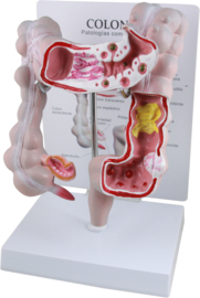 Anatomisch model Dikke darm met diverse ziektebeelden