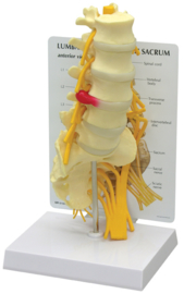 Anatomisch model 5 wervels met heiligbeen en hernia