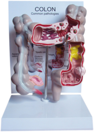 Anatomisch model Dikke darm met diverse ziektebeelden