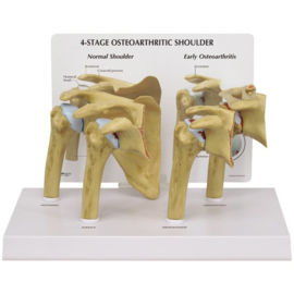 Anatomisch model Schouder met 4 fasen artrose