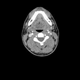 Erler Zimmer Hoofd-hals voor de training van CT, Röntgen- en radiotherapie