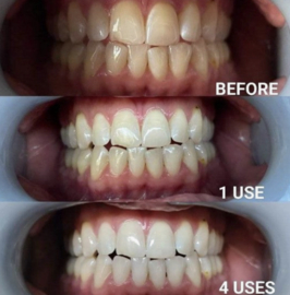 Smart tandpasta whitening