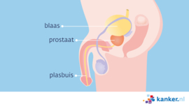 Plasbuiskanker