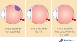 Afbeelding Oogmelanoom (uveamelanoom) varianten