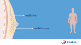 Borstkanker bij mannen