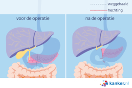 Afbeelding Whipple-operatie