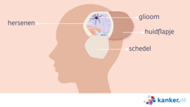 Afbeelding Craniotomie bij glioom