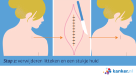 Afbeelding Excisie stap 2 - verwijderen litteken en een stukje huid