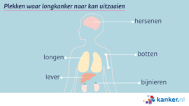 Afbeelding Uitzaaiingen op afstand van longkanker