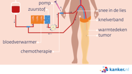 Afbeelding Voorbeeld perfusiebehandeling been