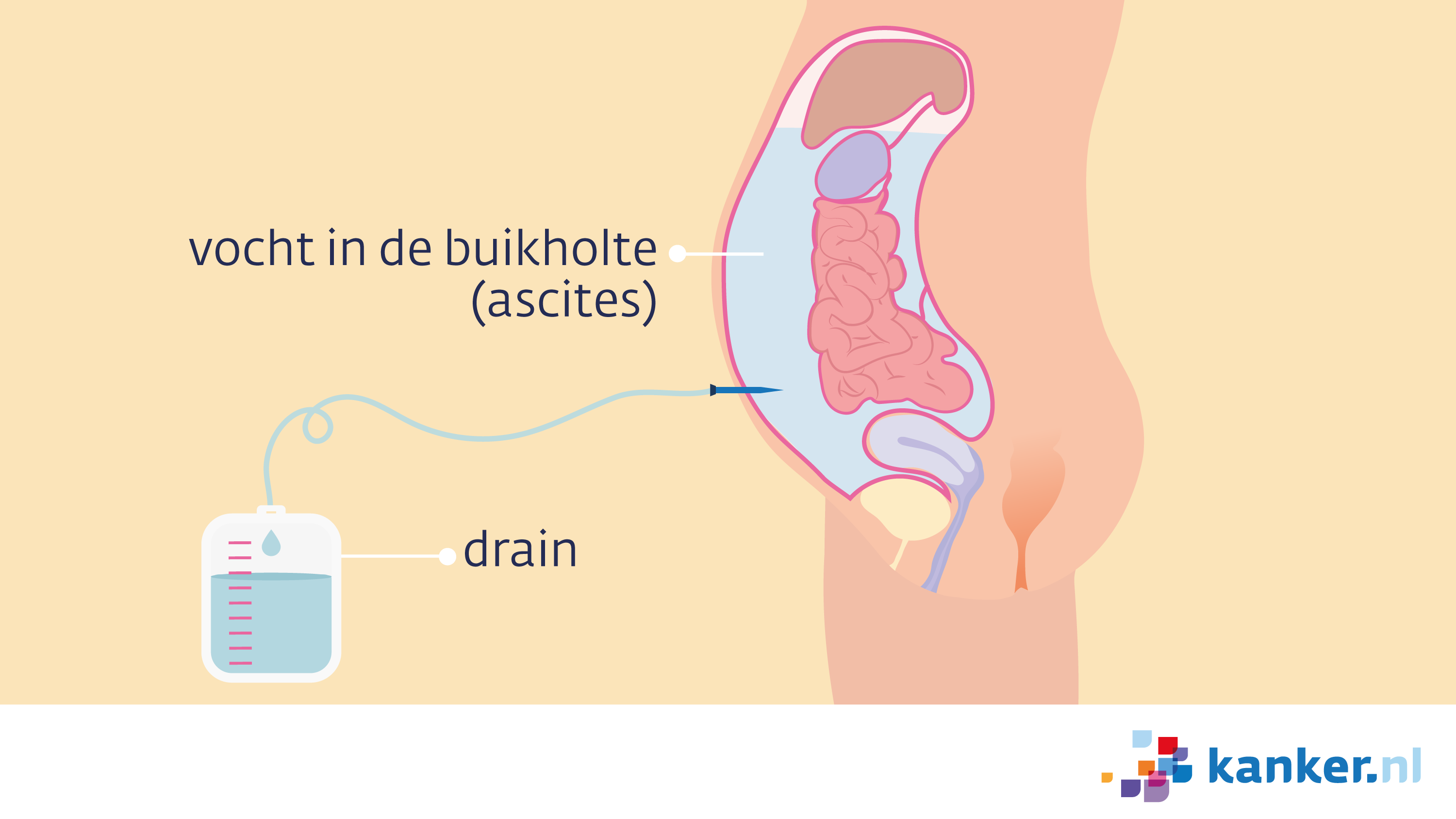 Afbeelding Drain bij vocht in de buikholte - ascitesdrain