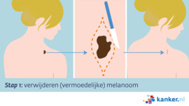 Afbeelding Excisie stap 1 - verwijderen vermoedelijke melanoom