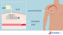 Afbeelding Chemotherapie  - Poortkatheter (port-a-cath)