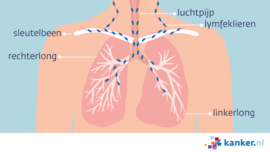 Afbeelding Regionale uitzaaiingen van longkanker