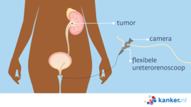 Afbeelding Ureterorenoscopie