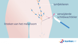 Afbeelding Stap 2: schildwachtklier verwijderen