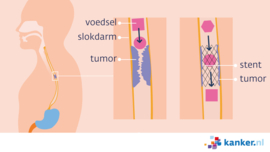 Afbeelding Een stent bij slokdarmkanker