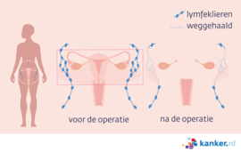 Afbeelding Baarmoederhalskanker radicale hysterectomie