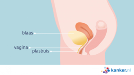 Afbeelding De plasbuis bij de vrouw