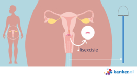 Afbeelding Baarmoederhalskanker lisexcisie